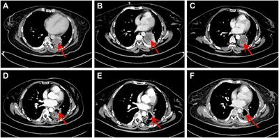 Posterior reversible encephalopathy syndrome after anlotinib treatment for small cell lung cancer: A case report and literature review